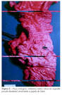 Os <b>adenomas</b> vilosos do trato