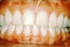 Periodontal (gum) Disease « SmilePlus's Blog
