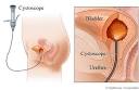 Cystoscopy of the bladder