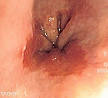 Barrett's esophagus - Wikipedia, the free encyclopedia