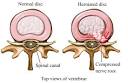 Herniated Disc (Cross Section)