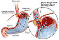 Gastrointestinal Problems in Triathletes