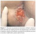 peri-<b>anal</b>, <b>doença</b> de Crohn