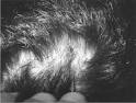 Concomitant or Consecutive Infection with Coxiella burnetii and ...