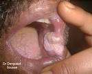 Kératoses pré epithéliomateuses et <b>leucoplasie</b>