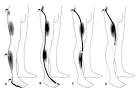 <b>Radiculopathy</b>