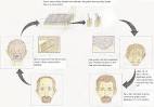 Hair Transplant Diagram - OmniMedicalSearch.