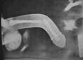 Penile Fracture definition with picture