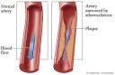 Atherosclerosis, sometimes