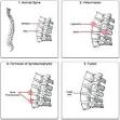 Ankylosing spondylitis - Wikipedia, the free encyclopedia