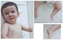 of <b>Moebius syndrome</b>.
