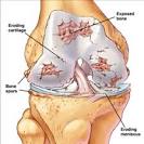 What is <b>Osteoarthritis</b>?