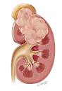 AUAF - Urology A-Z - Kidney Cancer