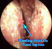 Nose Bleeds EPISTAXIS- Nose Bleeds
