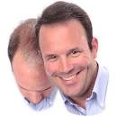 Take Care of Male Baldness
