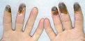 <b>Thromboangiitis Obliterans</b>