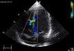 Echocardiography - Wikipedia, the free encyclopedia