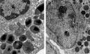 (B) <b>Acute eosinophilic</b>