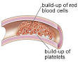 What you need to know about Hypercoagulable States (blood clotting ...