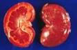 <b>Nephritis</b>.