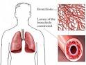 Bronchiectasis Disability Claims Help - Information - Representation