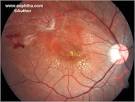 Eales' Disease by Dr Sandeep Saxena