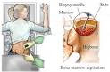 Gaucher Disease — UVA Health