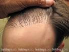 Hair Plugs in the Modern Era (with Photos) - Balding Blog