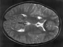 MRI scan <b>lyme neuroborreliosis</b>
