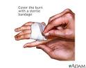 What is Minor burn - first aid - series?
