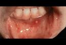 Hand-Foot-and-Mouth Disease in Mouth 2 Picture Image on MedicineNet.