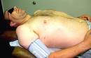 Anaphylactic shock