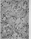Lipoma
