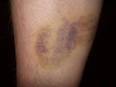 how to treat <b>hematoma</b> in the