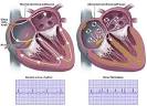 Atrial Fibrillation - Saint Vincent Health System