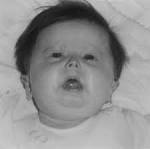 <b>Hallermann</b>-Streiff <b>syndrome</b>