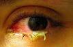allergic <b>conjunctivitis</b>