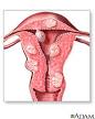 Uterine Fibroids: MedlinePlus