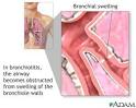 Bronchiolitis :: Nationwide Children's Hospital