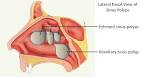 Nasal Polyps – Causes, Symptoms, Pictures, Treatment and Surgery
