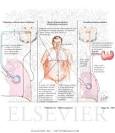 <b>Obesity Hypoventilation</b>