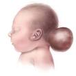 Datos sobre el <b>encefalocele</b>
