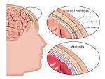 Meningitis, significado emocional | Peri��dico ��tico Global de.