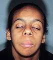 (<b>Langer</b>-<b>Giedion Syndrome</b>)