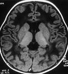 <b>Canavan disease</b> in a