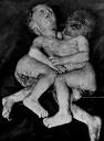 Siamese twins were hugely in