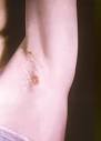 Help for Skin Rashes Including Pictures and Descriptions
