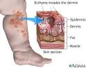 <b>Ecthyma</b> | UF Health, University of Florida Health
