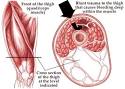 Quadriceps <b>contusion</b>