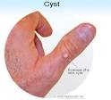 Cysts Symptoms, Types, Signs, Causes, Diagnosis and Treatment ...